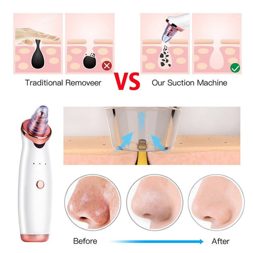 Vacuum Blackhead Remover Pimple Acne Removal Tool Skin Care Pore HairWorthy