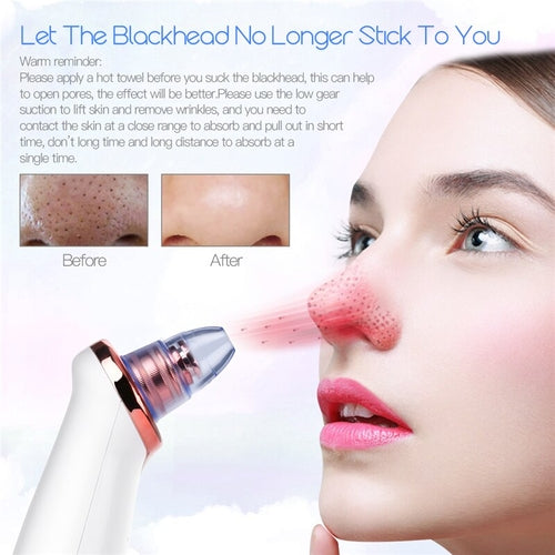 Vacuum Blackhead Remover Pimple Acne Removal Tool Skin Care Pore HairWorthy